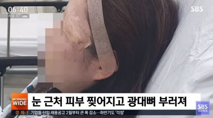 ▲ⓒ서울역 묻지마 폭행 피해자/SBS 뉴스 캡쳐