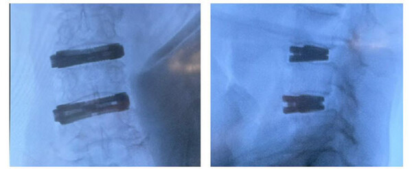 ▲엑셀픽스-XTP 적용 첫 수술 전면(왼쪽)과 엑셀픽스-XTP 적용 첫 수술 측면. ⓒ엘앤케이바이오메드